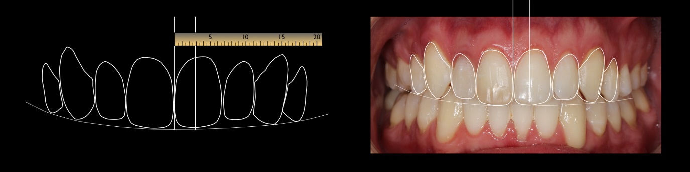 smile design 1 - DSD Digital Smile Design