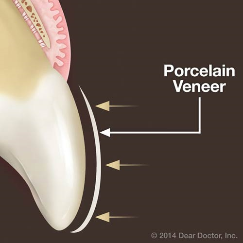 vaneer - DSD Digital Smile Design